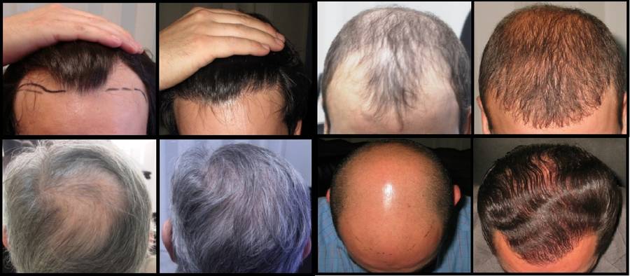 Los implantes capilares son perfectos para volver a vernos bien, pero no curan la alopecia!!